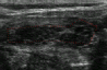 Sonographic image of thyroid gland